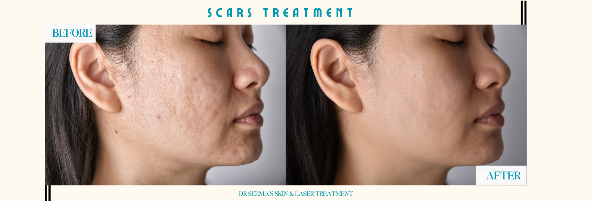 Scars_Treatment